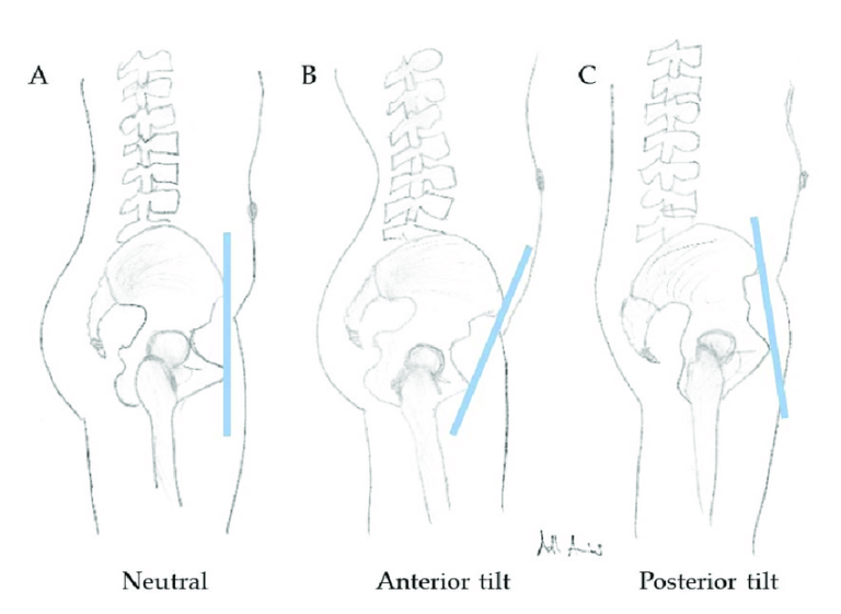 Normal Tilt Reposition How to Find Neutral in the Pelvis – Effortless Posture